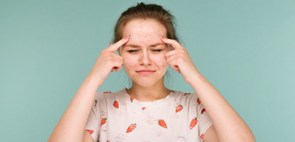 How To Treat Acne By Using Remedies At Home